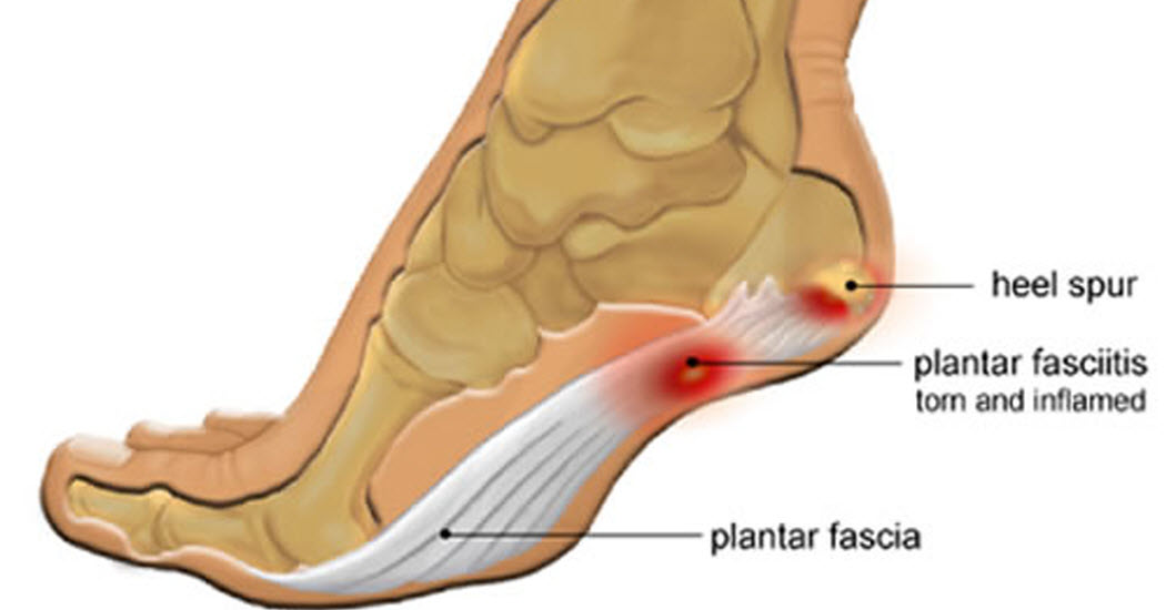 How To Prevent And Treat Plantar Fasciitis At Home – Useful Tips For Home