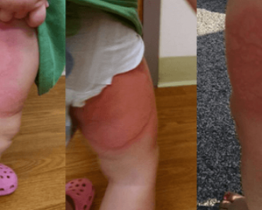 She Didn’t Know Why The Rash Was Spreading On Her Toddler’s Legs But Then She Found The Cereal Box