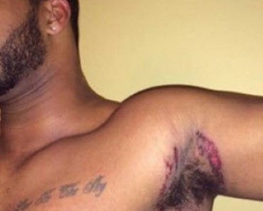 Man Claiming Famous Deodorant Brand Causing Chemical Burns