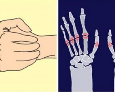 Is Cracking Your Knuckles Really Bad for You?
