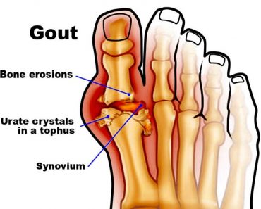How To Ease The Suffering Of Gout From Home And Stop Another Flare-up Before It Begins