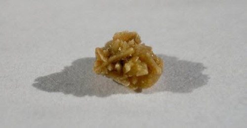 kidneystones