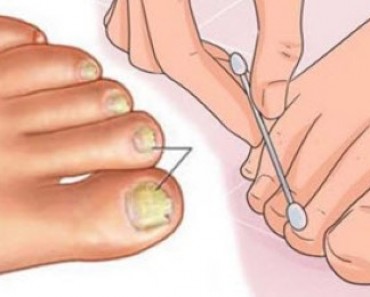 Try These Home Remedies for Toenail Fungus