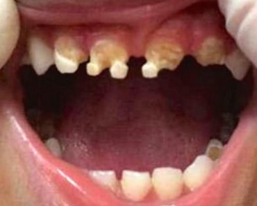 The Shocking State Of Our Children’s Teeth
