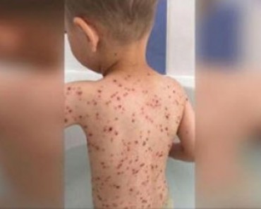 This Is Why You Should NEVER Give A Child with Chickenpox Ibuprofen