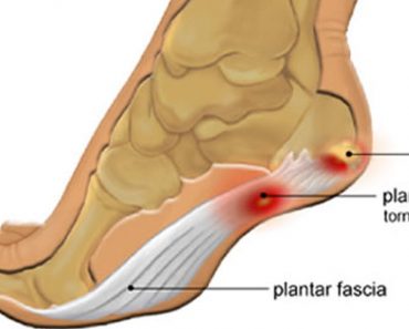 How to Prevent and Treat Plantar Fasciitis at Home
