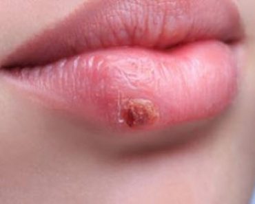 8 Ways to Remove a Cold Sore in Just One Day