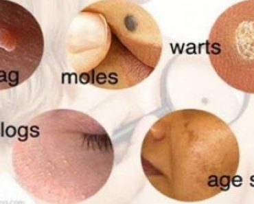 Natural Treatments for Skin Problems – Moles, Warts, Skin Tags, Blackheads and Age Spots