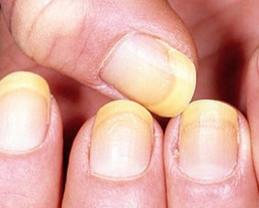 10 Things Your Nails Could Be Telling You about Your Health