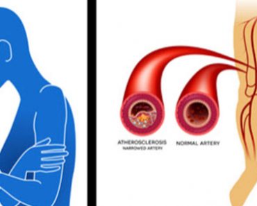 8 Signs And Symptoms You Have Poor Circulation / Peripheral Artery Disease