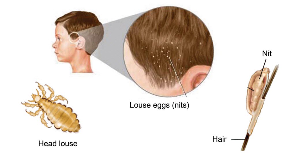 A Cheap Way To Remove Head Lice Almost Instantly – Useful Tips For Home