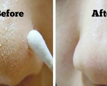 9 Ways To Remove Blackheads And Whiteheads Naturally