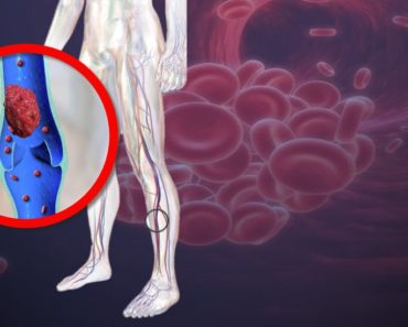 Pay Attention To These Common Symptoms Of A Blood Clot – It Could Save Your Life