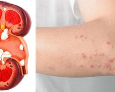 8 Signs Your Body Gives You If Your Kidney Is In Danger