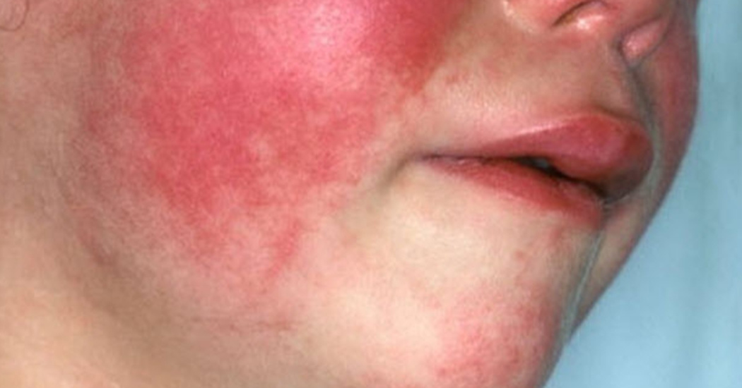 scarlet-fever-is-making-a-comeback-and-parents-need-to-know-the-warning