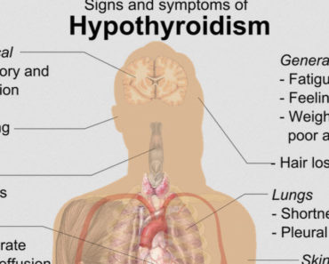 68 Signs Of Hypothyroidism. Order Tests Right Away If You Have Any Of Them