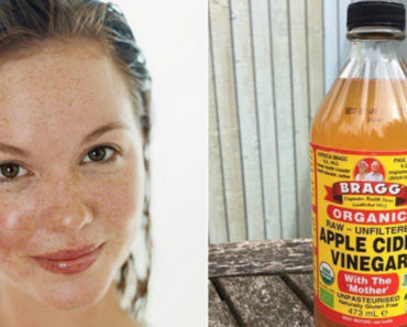 Put Some Apple Cider Vinegar On Your Face And Watch The Magic Happen To Age Spots, Acne, Etc.